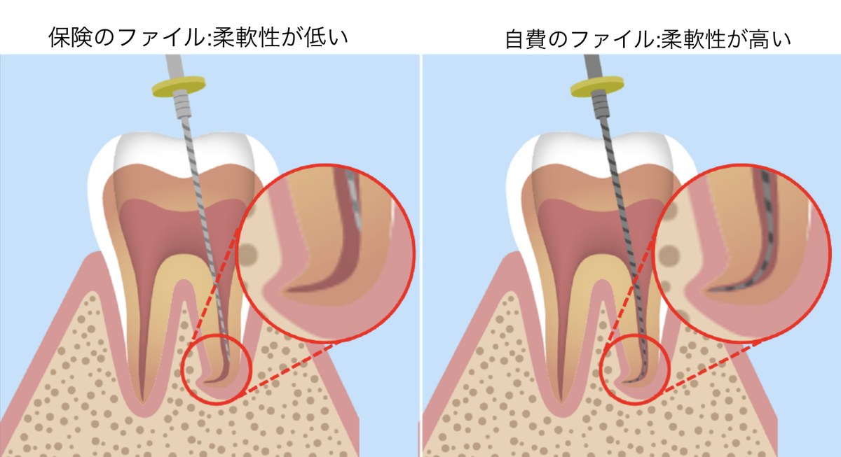 保険のステンレスファイルと自費のニッケルチタンファイルの柔軟性の違いの図