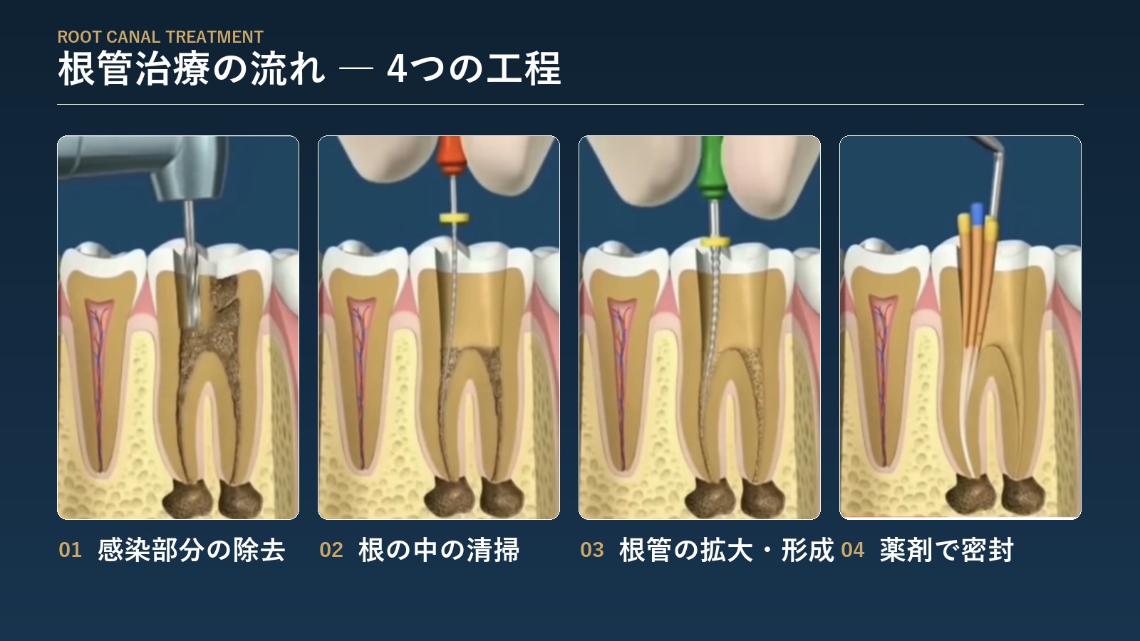 根管治療の流れの図(むし歯・感染部分の除去→根の中の清掃→根管の拡大・形成→薬剤で密封)
