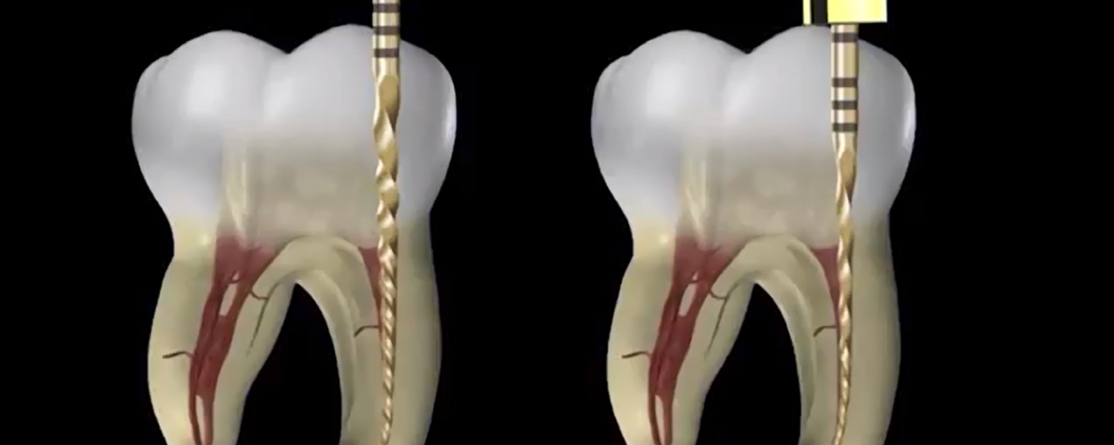 歯の根の中に入ったニッケルチタンファイルの3DCG図